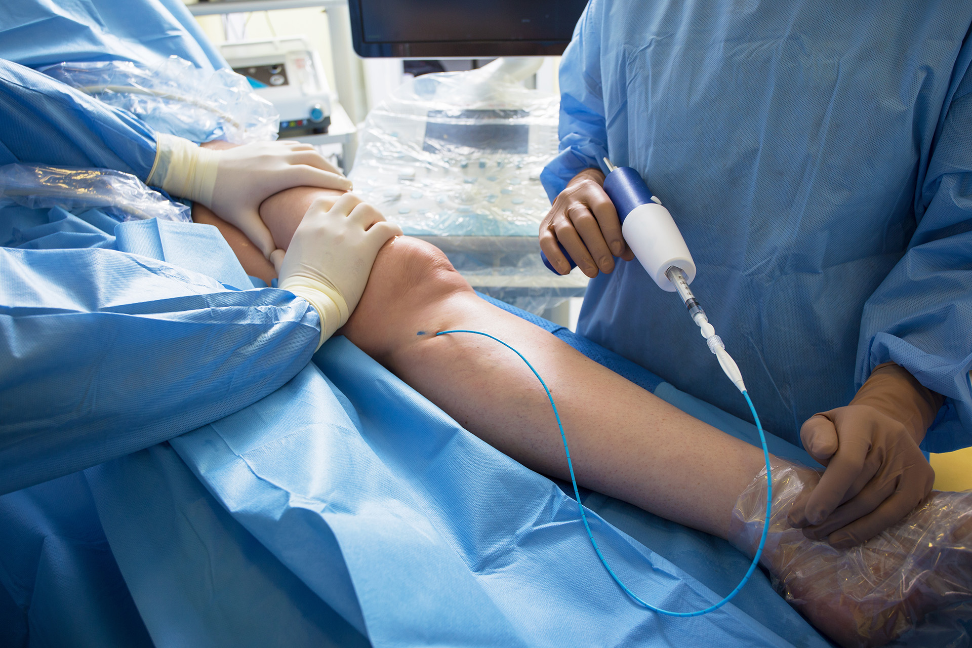 venaseal glue closure procedure in ontario