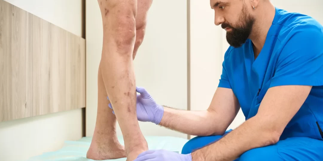 Doctor treating varicose vein of patient